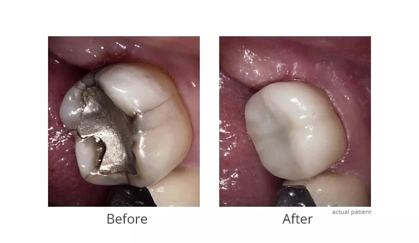 Before and After Dental Crowns 4