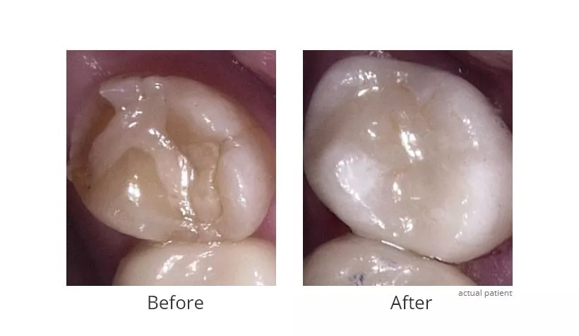 Before and After Dental Crowns 3