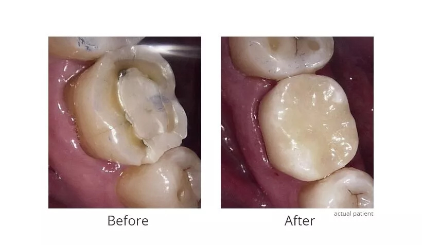 Before and After Dental Crowns 2