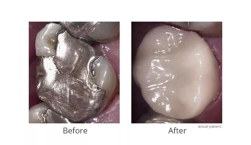 Before and After Dental Crowns 1