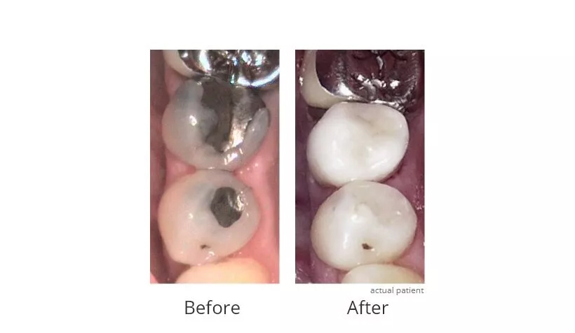 Before and After Dental Crowns