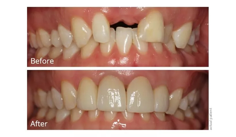 Before and After Dental Implants
