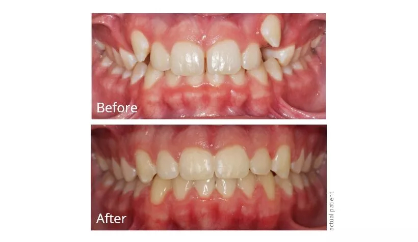 Before and After the Teeth Realignment