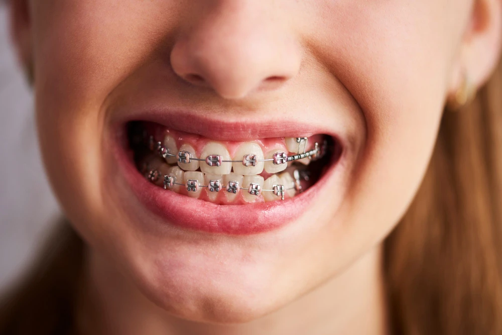 A female smiling with braces