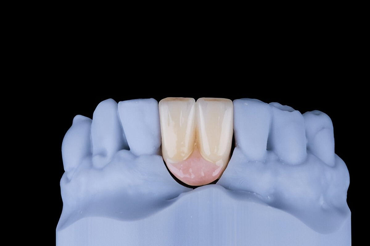 dental crowns in lendrum
