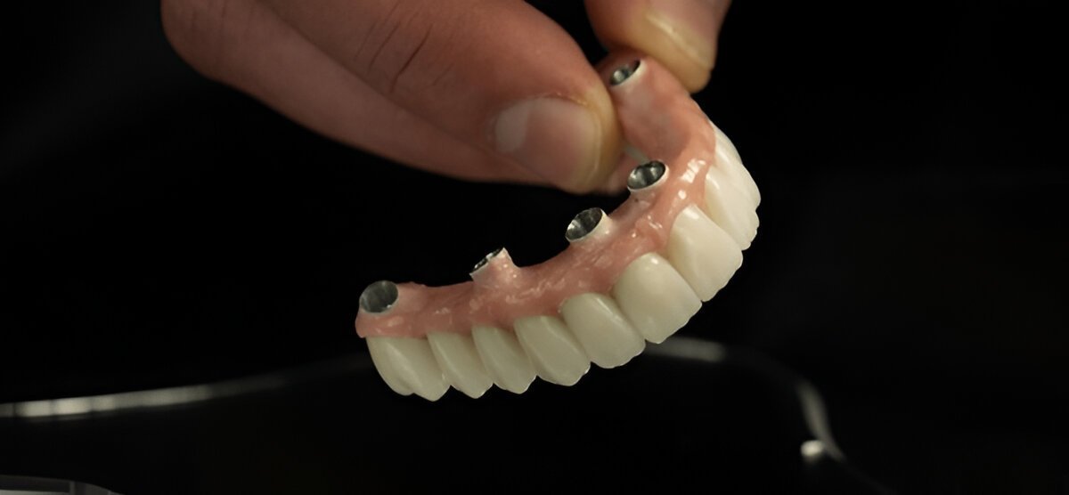 dental implants near you