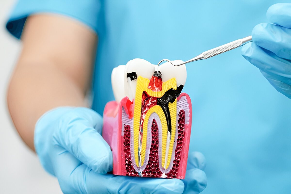 root canal treatment in lendrum